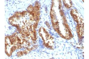 Formalin-fixed, paraffin-embedded human Prostate Carcinoma stained with AMACR / p504S Rabbit Polyclonal Antibody. (AMACR Antikörper)