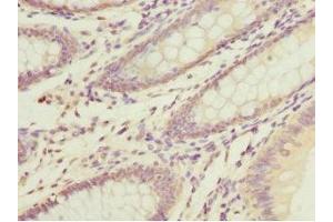 Immunohistochemistry of paraffin-embedded human colon cancer using ABIN7150497 at dilution of 1:100 (DNAJA2 Antikörper  (AA 233-412))