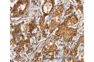 Immunohistochemistry of Human liver cancer using SLC5A11 Polyclonal Antibody at dilution of 1:35 (Solute Carrier Family 5 (Sodium/inositol Cotransporter), Member 11 (SLC5A11) Antikörper)