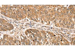 Immunohistochemistry of paraffin-embedded Human lung cancer using RPLP2 Polyclonal Antibody at dilution of 1:35 (RPLP2 Antikörper)