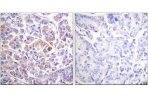 Immunohistochemistry analysis of paraffin-embedded human breast carcinoma tissue, using C-RAF (Ab-296) Antibody. (RAF1 Antikörper  (AA 271-320))