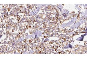 ABIN6276766 at 1/100 staining Human Melanoma tissue by IHC-P. (SPARC Antikörper  (Internal Region))