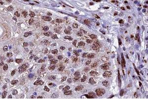 ABIN6266678 at 1/100 staining human lung carcinoma tissue sections by IHC-P. (XRCC3 Antikörper  (N-Term))
