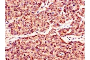 Immunohistochemistry of paraffin-embedded human ovarian cancer using ABIN7146893 at dilution of 1:100 (CSNK2B Antikörper  (AA 1-215))