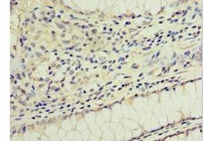 Immunohistochemistry of paraffin-embedded human colon cancer using ABIN7154311 at dilution of 1:100 (GS28 Antikörper  (AA 1-115))