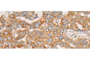 Immunohistochemistry of paraffin-embedded Human liver cancer tissue using ATXN7 Polyclonal Antibody at dilution of 1:60(x200) (ATXN7 Antikörper)