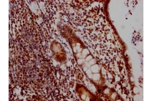 IHC image of ABIN7127450 diluted at 1:100 and staining in paraffin-embedded human colon cancer performed on a Leica BondTM system. (Rekombinanter DDX5 Antikörper)