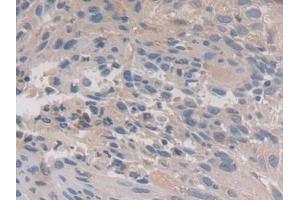 Detection of CAPN3 in Human Lung cancer Tissue using Polyclonal Antibody to Calpain 3 (CAPN3)
