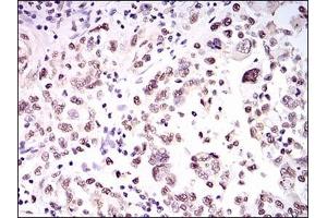Immunohistochemical analysis of paraffin-embedded human endometrial cancer tissues using HNRNPU mouse mAb with DAB staining. (HNRNPU Antikörper)