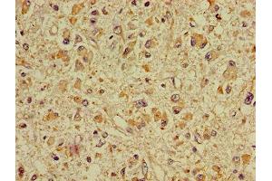Immunohistochemistry of paraffin-embedded human glioma using ABIN7149930 at dilution of 1:100