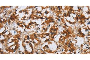 Immunohistochemistry of paraffin-embedded Human thyroid cancer tissue using DSP Polyclonal Antibody at dilution 1:40