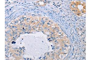 The image on the left is immunohistochemistry of paraffin-embedded Human cervical cancer tissue using ABIN7128287(AGBL5 Antibody) at dilution 1/30, on the right is treated with fusion protein. (AGBL5 Antikörper)