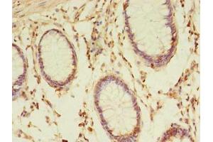 Immunohistochemistry of paraffin-embedded human colon cancer using ABIN7172979 at dilution of 1:100 (TMED3 Antikörper  (AA 24-180))