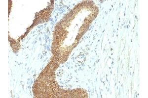 Formalin-fixed, paraffin-embedded human Colon Carcinoma stained with Alkaline Phosphatase Mouse Monoclonal Antibody (ALPL/597). (ALPL Antikörper)