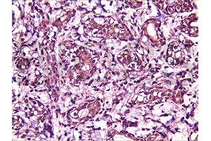 Formalin-fixed and paraffin embedded human breast carcinoma labeled with Anti-BRMS-1 Polyclonal Antibody, Unconjugated (ABIN730933) at 1:200, followed by conjugation to the secondary antibody and DAB staining (BRMS1L Antikörper  (AA 151-246))