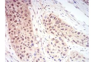 Immunohistochemical analysis of paraffin-embedded esophageal cancer tissues using RAN mouse mAb with DAB staining. (RAN Antikörper  (AA 1-216))