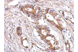 IHC-P Image Immunohistochemical analysis of paraffin-embedded human gastric cancer, using LHR, antibody at 1:500 dilution. (LHCGR Antikörper  (C-Term))