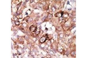 IHC analysis of FFPE human hepatocarcinoma tissue stained with the Bad antibody