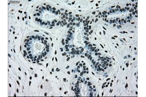Immunohistochemical staining of paraffin-embedded breast tissue using anti-SILV mouse monoclonal antibody. (Melanoma gp100 Antikörper)