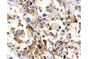 Immunohistochemistry analysis of paraffin-embedded human lung cancer using AQP1 Polyclonal Antibody at dilution of 1:400. (Aquaporin 1 Antikörper)