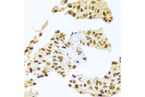 Immunohistochemistry of paraffin-embedded human lung cancer using SMEK1 antibody (ABIN5974870) at dilution of 1/100 (40x lens). (SMEK1 Antikörper)