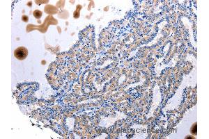 Immunohistochemistry of Human stomach cancer using UTS2 Polyclonal Antibody at dilution of 1:100 (Urotensin 2 Antikörper)