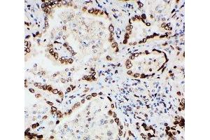 IHC-P: Lamin A/C antibody testing of human lung cancer tissue (Lamin A/C Antikörper  (AA 455-469))