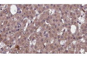 ABIN6277556 at 1/100 staining Human liver cancer tissue by IHC-P.