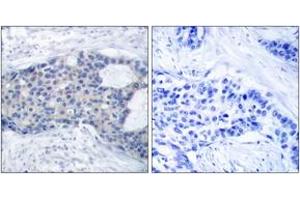 Immunohistochemistry analysis of paraffin-embedded human breast carcinoma, using ZAP-70 (Phospho-Tyr493) Antibody.