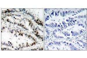 Immunohistochemical analysis of paraffin-embedded human lung carcinoma tissue using SMC1 (phospho-Ser957) antibody (E011198). (SMC1A Antikörper  (pSer957))