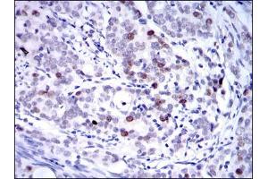 Immunohistochemical analysis of paraffin-embedded cervical cancer tissues using KID mouse mAb with DAB staining. (KIF22 Antikörper)