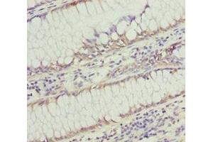 Immunohistochemistry of paraffin-embedded human colon cancer using ABIN7171004 at dilution of 1:100 (SOCS4 Antikörper  (AA 1-270))