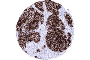Pancreas Acinar cell carcinoma showing strong GP 2 immunostaining of all tumor cells (GP2 Antikörper  (AA 35-179))