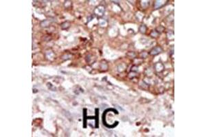 Formalin-fixed and paraffin-embedded human hepatocellular carcinoma tissue reacted with BLK polyclonal antibody  , which was peroxidase-conjugated to the secondary antibody, followed by AEC staining. (BLK Antikörper  (N-Term))