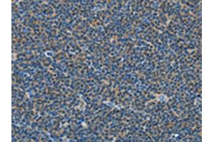 The image on the left is immunohistochemistry of paraffin-embedded Human lymphoma tissue using ABIN7129020(COX7B2 Antibody) at dilution 1/15, on the right is treated with fusion protein. (COX7B2 Antikörper)