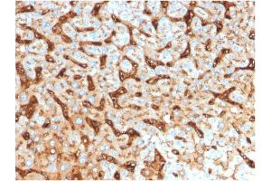 Formalin-fixed, paraffin-embedded human Hepatocellular Carcinoma stained with Albumin Mouse Monoclonal Antibody (ALB/2144).