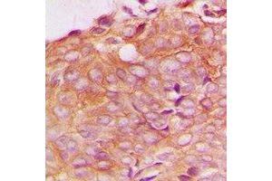 Immunohistochemical analysis of SPTBN1 staining in human breast cancer formalin fixed paraffin embedded tissue section.