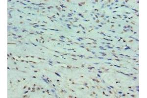 Immunohistochemistry of paraffin-embedded human breast cancer using ABIN7165931 at dilution of 1:100 (DARPP32 Antikörper  (Regulatory Subunit 1B))