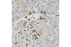 Immunohistochemistry of paraffin-embedded human liver injury using BEST1 antibody. (Bestrophin 1 Antikörper  (AA 200-300))