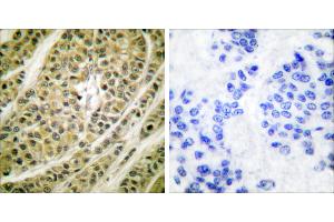 Peptide - +Immunohistochemical analysis of paraffin-embedded human breast carcinoma tissue using HDAC5 antibody (#C0225). (HDAC5 Antikörper)