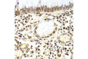 Immunohistochemistry of paraffin-embedded human gastric cancer using MCM4 Antibody (ABIN5971548) at dilution of 1/200 (40x lens). (MCM4 Antikörper)