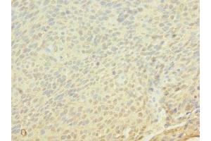 Immunohistochemistry of paraffin-embedded human cervical cancer using ABIN7152849 at dilution of 1:100 (FRS3 Antikörper  (AA 101-400))
