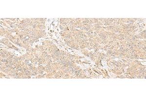 Immunohistochemistry of paraffin-embedded Human ovarian cancer tissue using TRAF6 Polyclonal Antibody at dilution of 1:30(x200) (TRAF6 Antikörper)