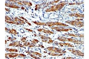 Formalin-fixed, paraffin-embedded human Leiomyosarcoma stained with SMMHC antibody (MYH11/923 + SMMS-1). (MYH11 Antikörper)