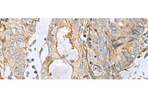 Immunohistochemistry of paraffin-embedded Human colorectal cancer tissue using MTHFD2 Polyclonal Antibody at dilution of 1:65(x200)