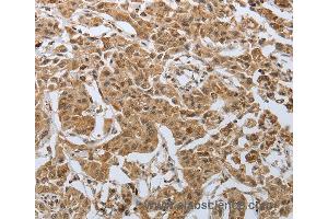 Immunohistochemistry of Human lung cancer using PSMD6 Polyclonal Antibody at dilution of 1:50 (PSMD6 Antikörper)
