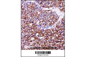BAG2 Antibody immunohistochemistry analysis in formalin fixed and paraffin embedded human ovarian carcinoma followed by peroxidase conjugation of the secondary antibody and DAB staining. (BAG2 Antikörper  (C-Term))