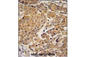 AWAT2 Antibody (C-term) (ABIN654780 and ABIN2844461) immunohistochemistry analysis in formalin fixed and paraffin embedded human skin carcinoma followed by peroxidase conjugation of the secondary antibody and DAB staining. (AWAT2 Antikörper  (C-Term))