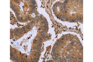 Immunohistochemistry of Human colon cancer using FHL2 Polyclonal Antibody at dilution of 1:50
