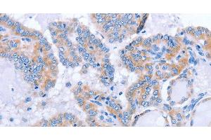 Immunohistochemistry of paraffin-embedded Human thyroid cancer tissue using FGF4 Polyclonal Antibody at dilution 1:40